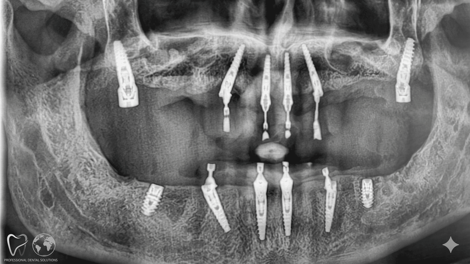 Risultato Corone in Zirconia — Francesca D.