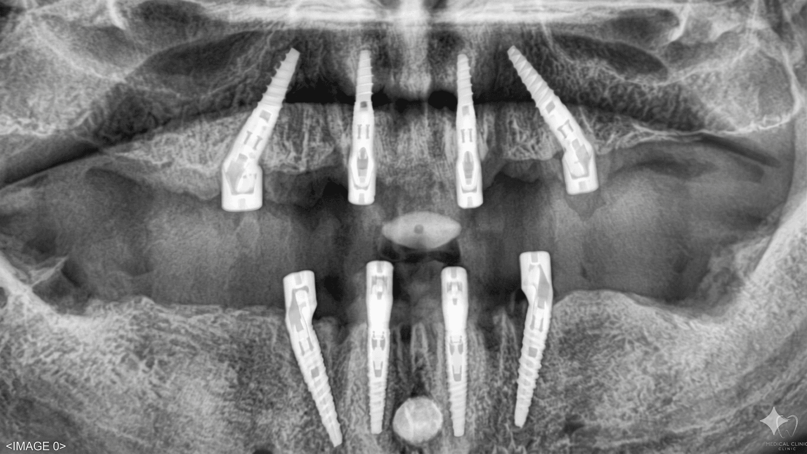 Passo 4: Trattamento in Clinica